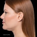 Kybella Before & After Patient #288