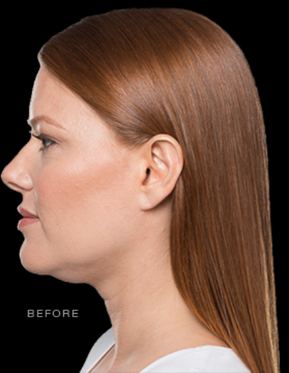 Kybella Before & After Patient #288