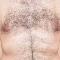 Laser Hair Removal Before & After Patient #304