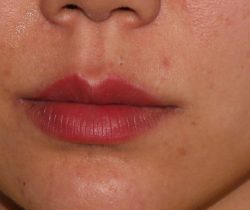 Lip Fillers Before & After Patient #315