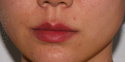 Lip Fillers Before & After Patient #315