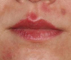 Lip Fillers Before & After Patient #316