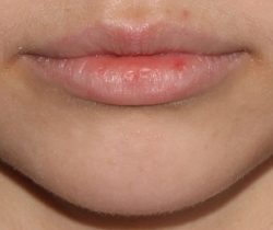 Lip Fillers Before & After Patient #317