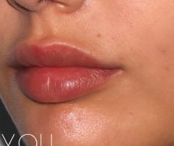Lip Fillers Before & After Patient #318