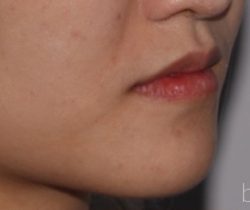 Lip Fillers Before & After Patient #319