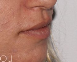 Lip Fillers Before & After Patient #320