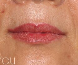 Lip Fillers Before & After Patient #321
