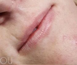 Lip Fillers Before & After Patient #323