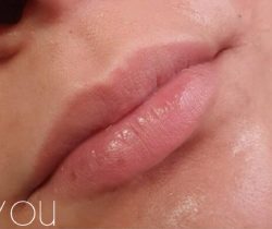 Lip Fillers Before & After Patient #324
