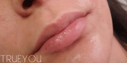 Lip Fillers Before & After Patient #324