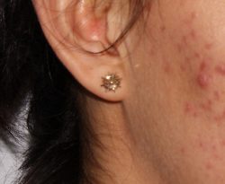 Microneedling Before & After Patient #342