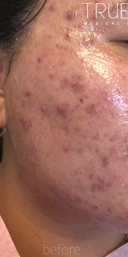 Microneedling Before & After Patient #343