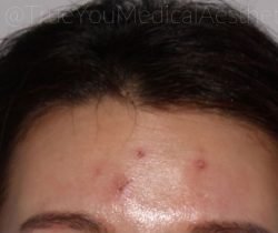 Microneedling Before & After Patient #344