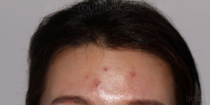 Microneedling Before & After Patient #344