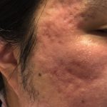 Microneedling Before & After Patient #345