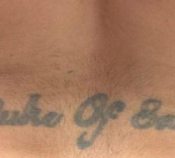Picosure Before & After Patient #357