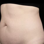 Sculpsure Before & After Patient #371