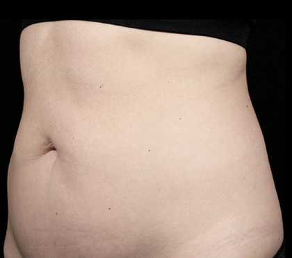 Sculpsure Before & After Patient #371