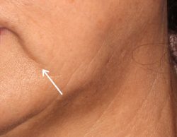 Juvederm Fillers Before & After Patient #270