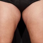 Sculpsure Before & After Patient #374