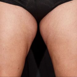 Sculpsure Before & After Patient #374