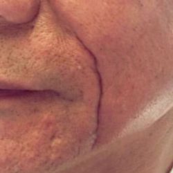 Juvederm Fillers Before & After Patient #271