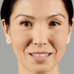 Juvederm Fillers Before & After Patient #272