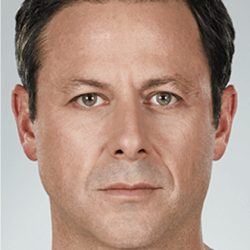Juvederm Fillers Before & After Patient #273