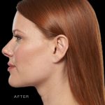 Kybella Before & After Patient #288