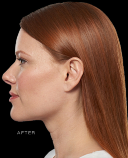 Kybella Before & After Patient #288