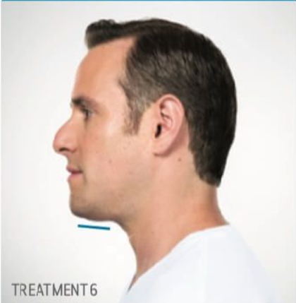 Kybella Before & After Patient #289