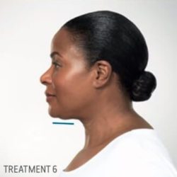 Kybella Before & After Patient #290