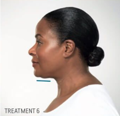 Kybella Before & After Patient #290