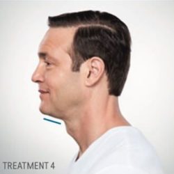 Kybella Before & After Patient #291