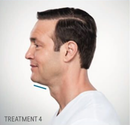 Kybella Before & After Patient #291