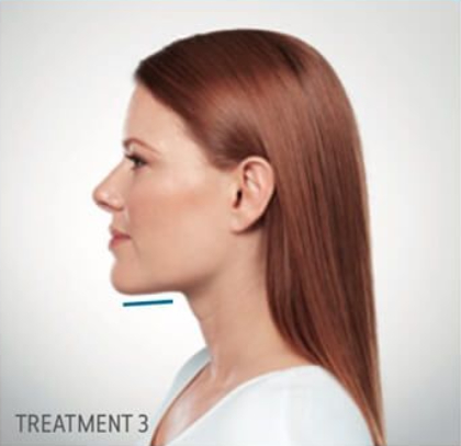 Kybella Before & After Patient #292