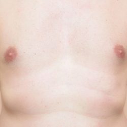 Laser Hair Removal Before & After Patient #304
