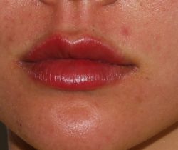Lip Fillers Before & After Patient #315