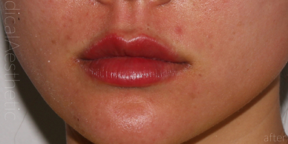 Lip Fillers Before & After Patient #315