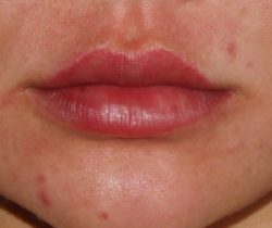 Lip Fillers Before & After Patient #316