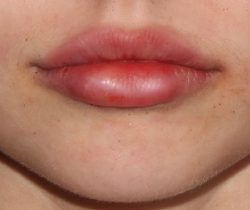 Lip Fillers Before & After Patient #317