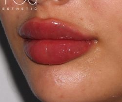 Lip Fillers Before & After Patient #318