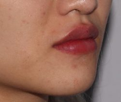 Lip Fillers Before & After Patient #319