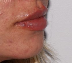 Lip Fillers Before & After Patient #320