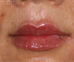 Lip Fillers Before & After Patient #321