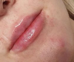 Lip Fillers Before & After Patient #323