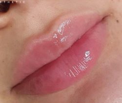 Lip Fillers Before & After Patient #324