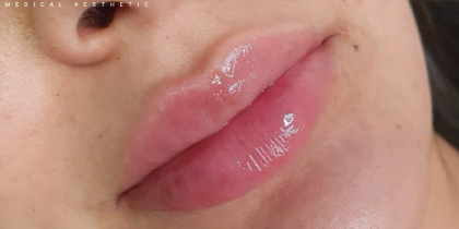 Lip Fillers Before & After Patient #324