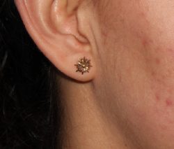 Microneedling Before & After Patient #342
