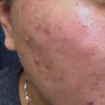 Microneedling Before & After Patient #343